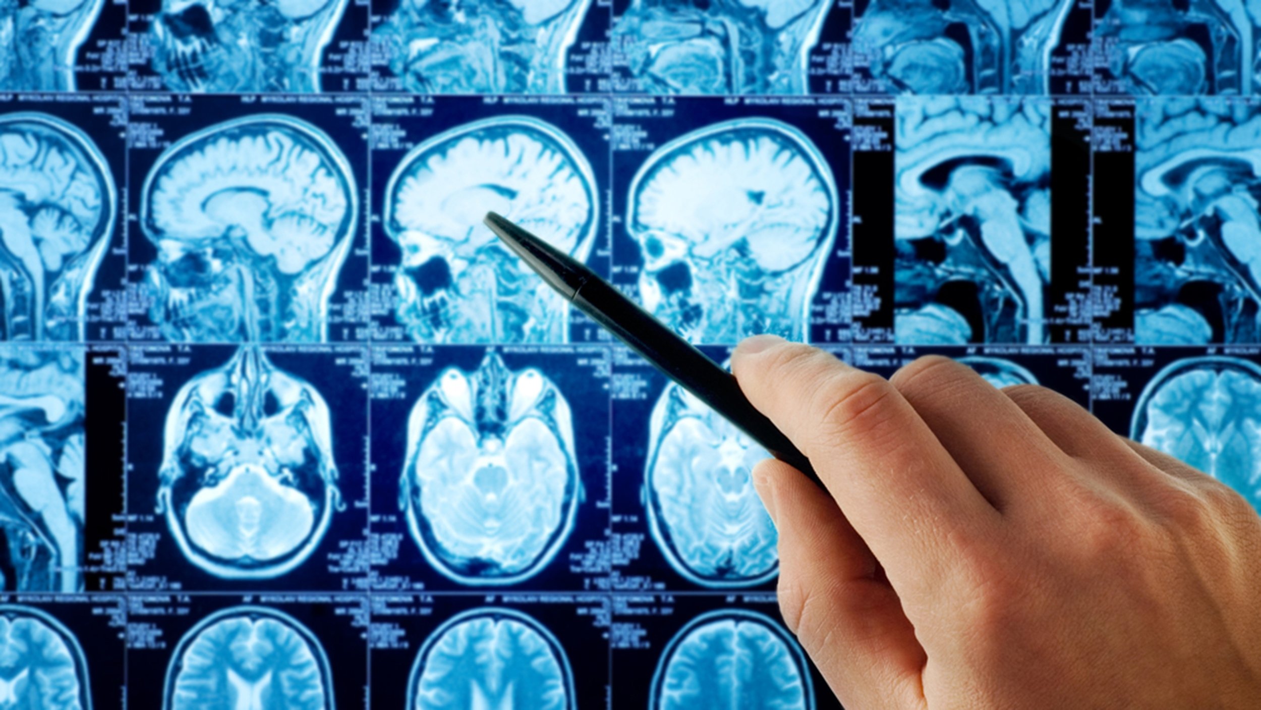 La scienza è divisa sull'argomento tumori e cellulari